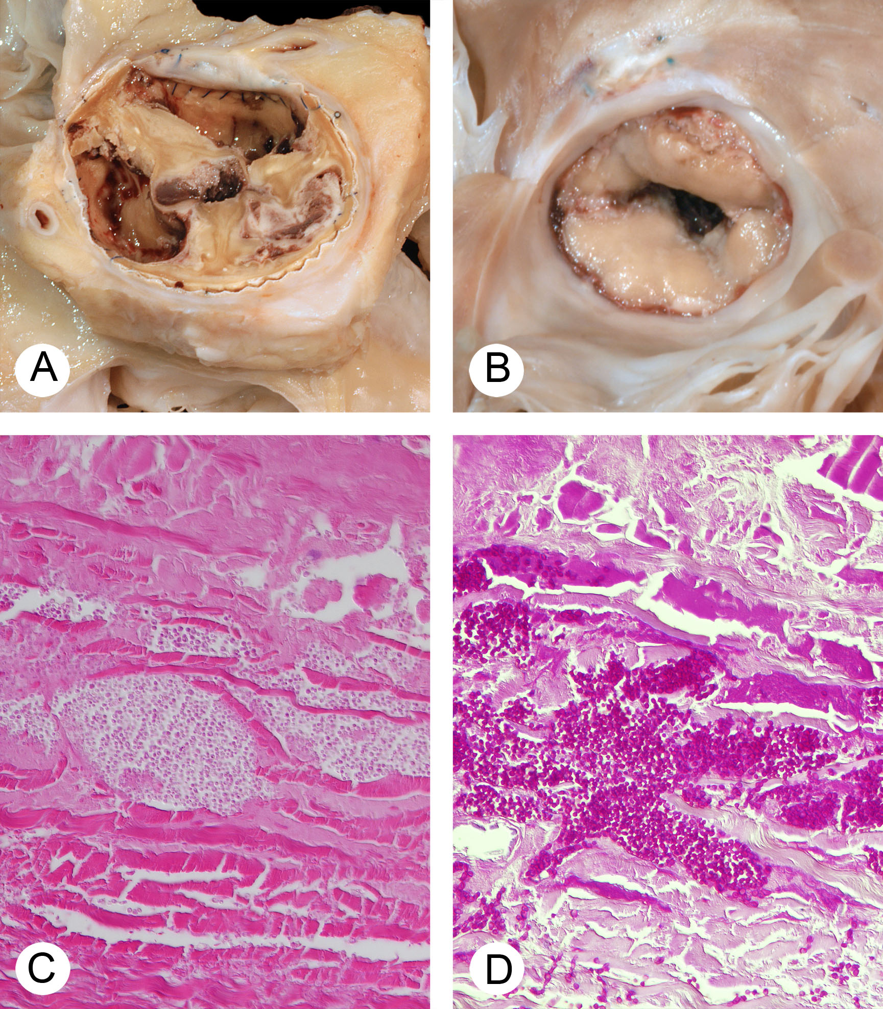 Prosthetic valve endocarditis  Candida